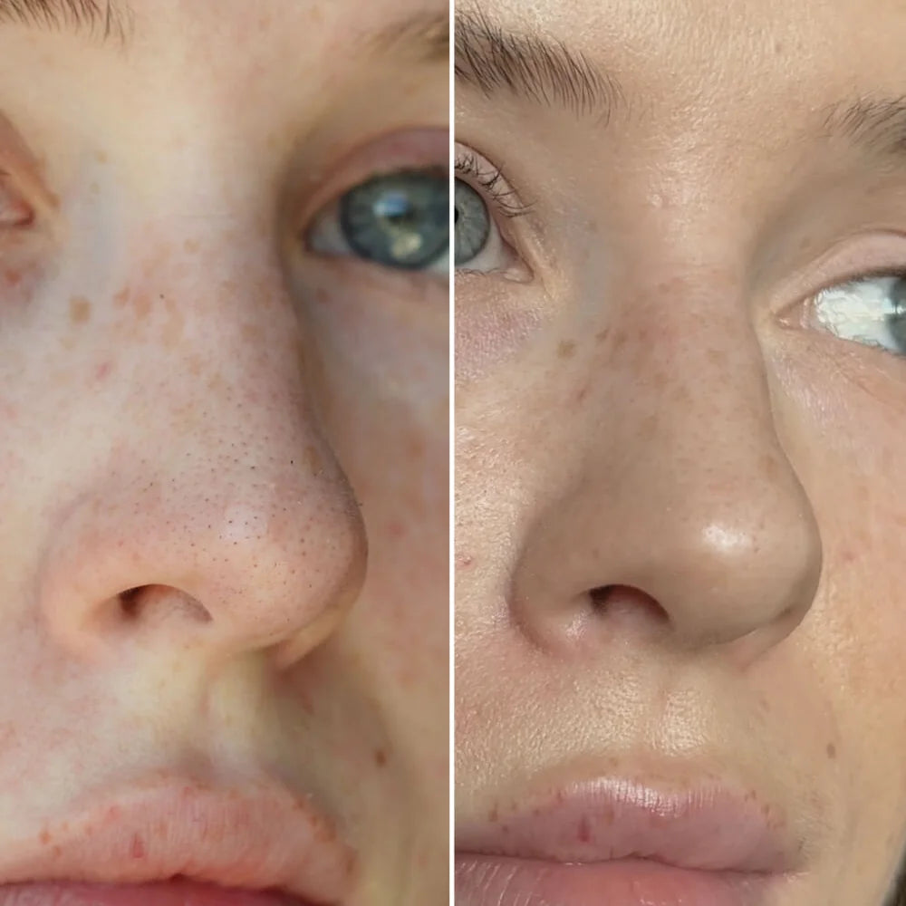 Zenmira Hydrocolloid Nose Patches — before after