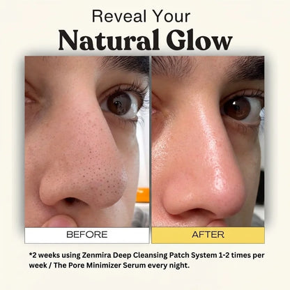 Zenmira Pore Cleansing Patch System — before after