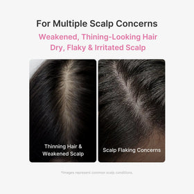 Zenmira Microneedling Rosemary Scalp Serum — scalp concerns