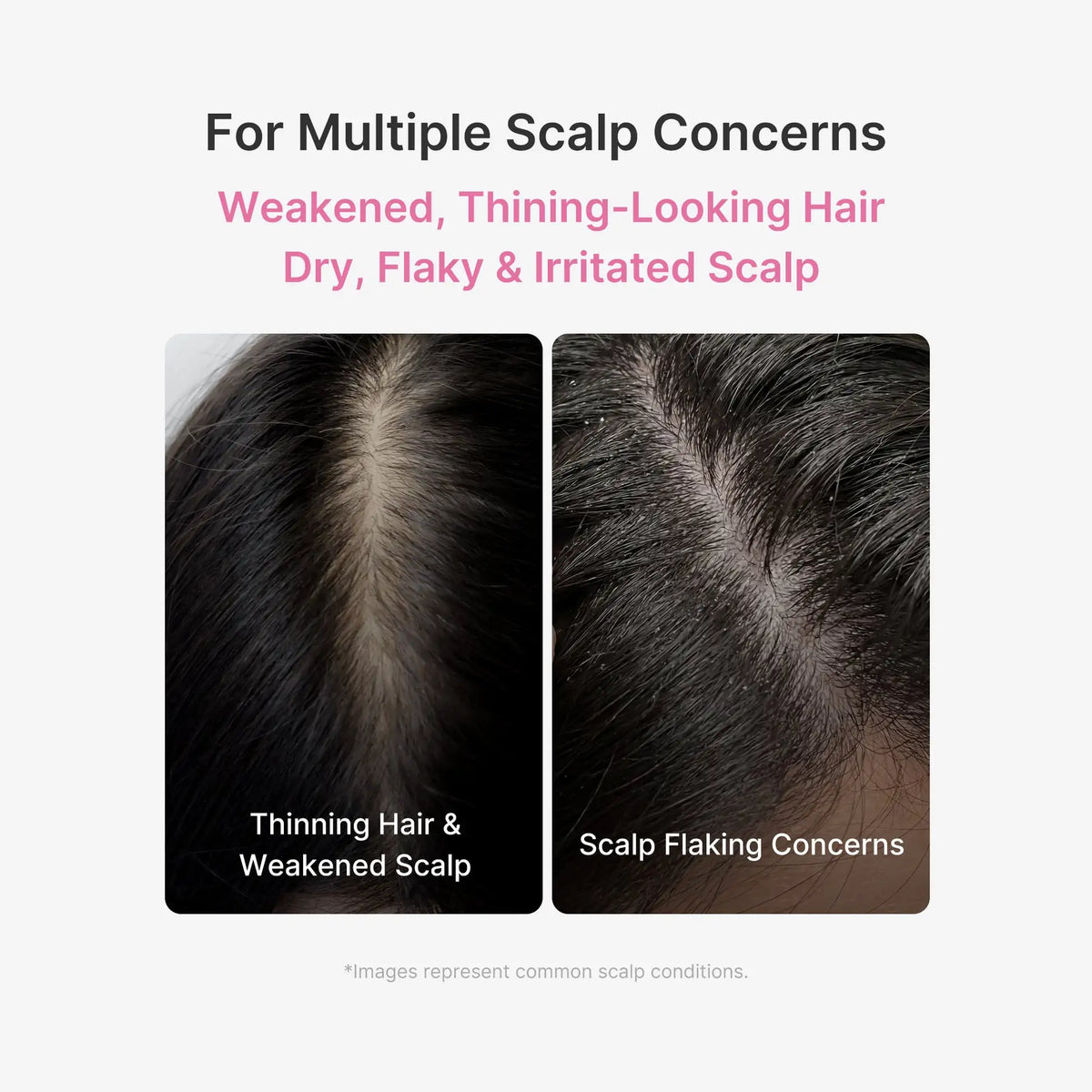 Zenmira Microneedling Rosemary Scalp Serum — scalp concerns